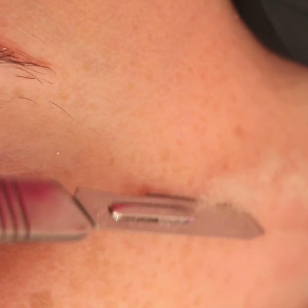 Lâmina de dermaplaning deslizando sobre a pele do rosto