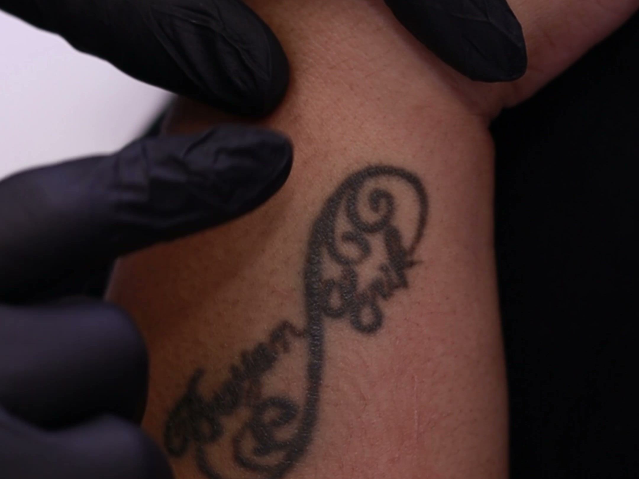 Tatuagem escura no braço de uma cliente antes da sessão de remoção a laser na Clínica da Barbe